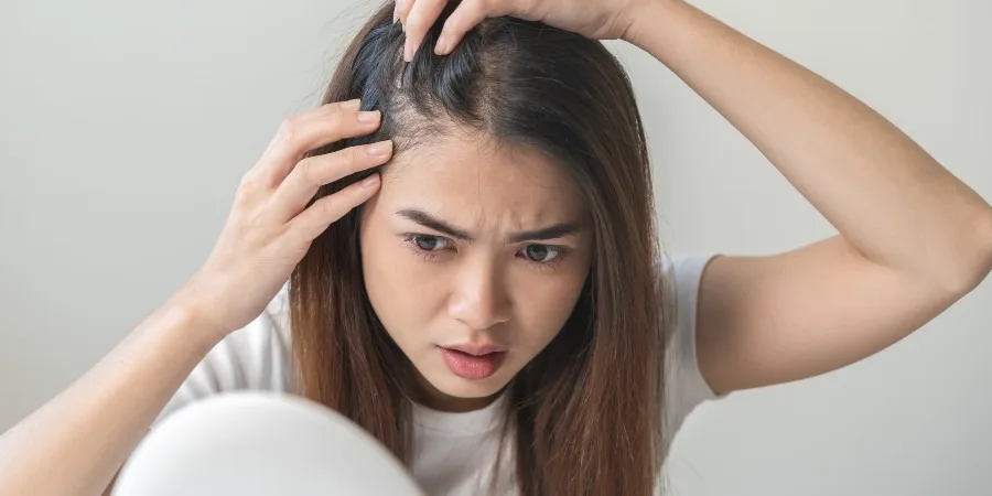 Natural Remedies for Dandruff - image