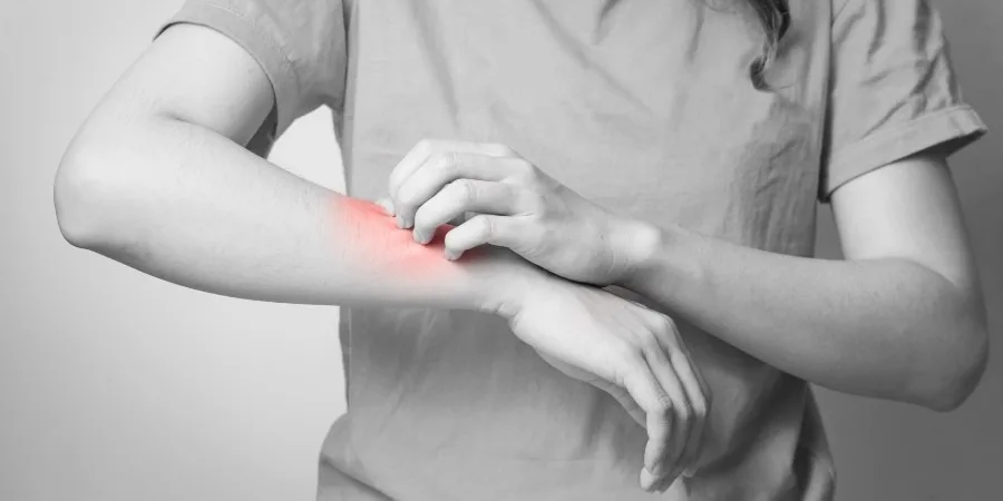 What You Need to Know About Flea Bites - image What You Need to Know About Flea Bites - image