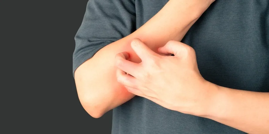 What You Need to Know About Flea Bites - image What You Need to Know About Flea Bites - image