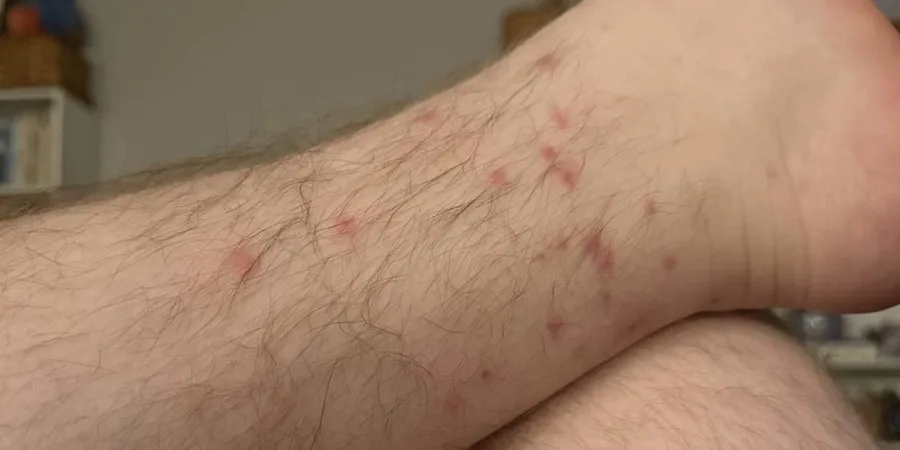 What You Need to Know About Flea Bites - image What You Need to Know About Flea Bites - image